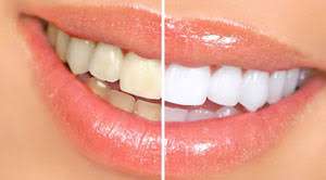 سفیدکننده‌های طبیعی دندان را بشناسید