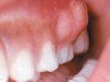چگونه آبسه دندان را درمان کنیم؟