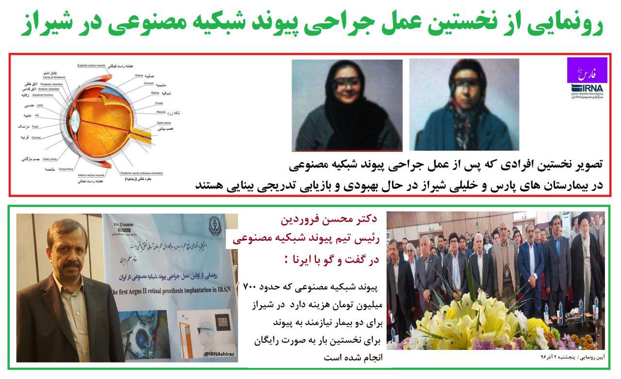 پزشکان شیرازی نخستین عمل پیوند شبکیه مصنوعی ایران را انجام دادند