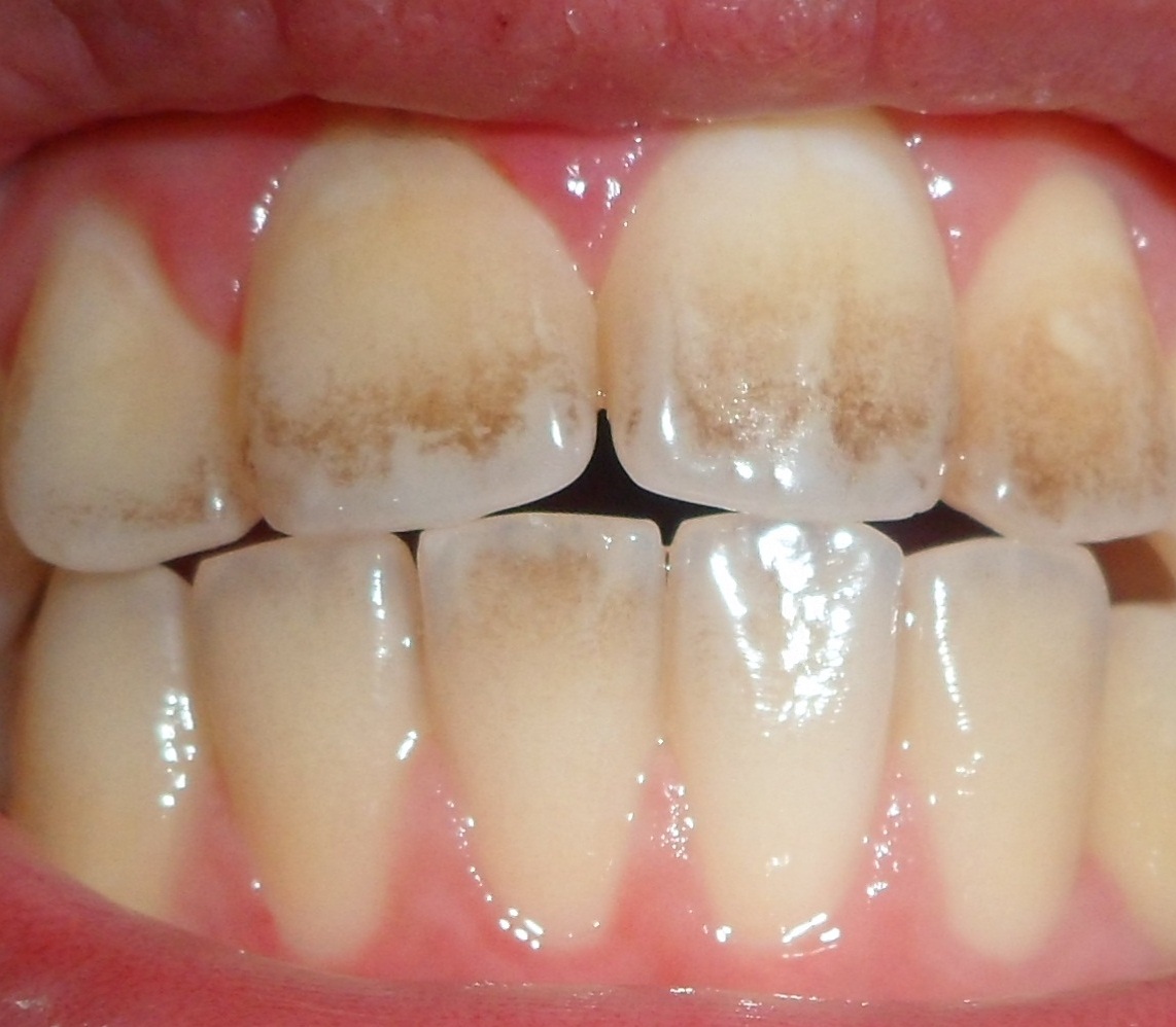 هر آنچه باید برای پیشگیری از پوسیدگی دندان بدانید