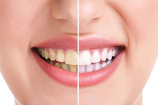 روش های سفید کردن دندان ها