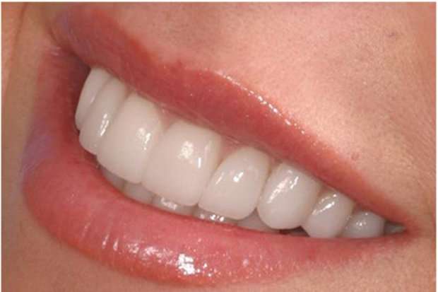 ارتودنسی می‌تواند طول عمر دندان‌ها را افزایش دهد