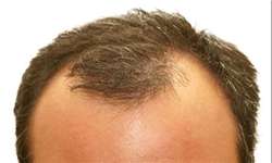 ریزش مجدد موی کاشته شده با اختلالات تیروئیدی