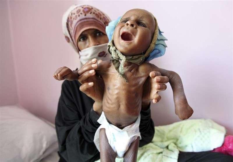 یونیسف: یک‌میلیون و ۸۰۰ هزار کودک یمنی از سوء‌تغذیه شدید رنج می‌برند