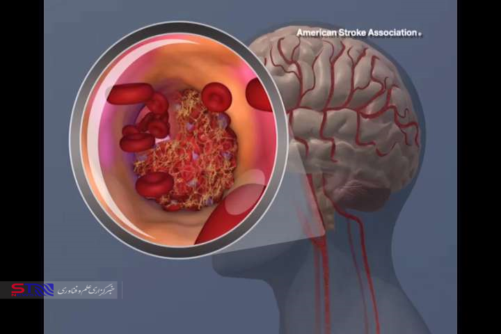 یک سوراخ در قلب باعث افزایش خطر سکته مغزی پس از جراحی می شود