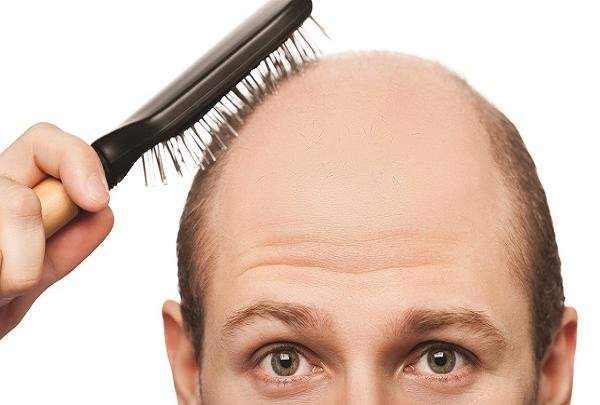 درمان ریزش مو با داروی پوکی استخوان