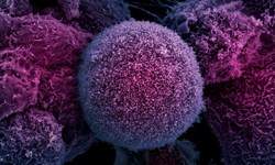 سرطان سینه دومین علت مرگ زنان