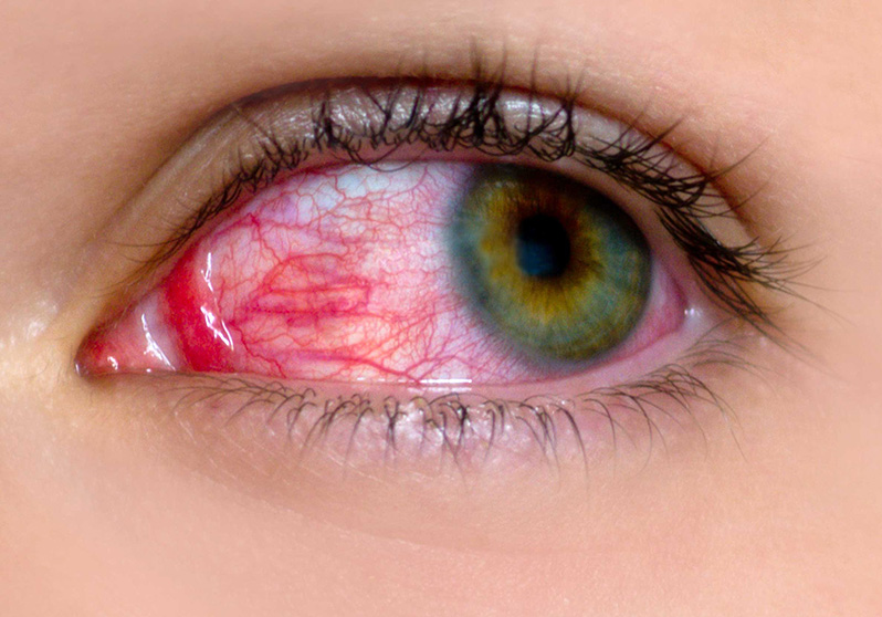 علت قرمزی چشم و خطرات ناشی از آن
