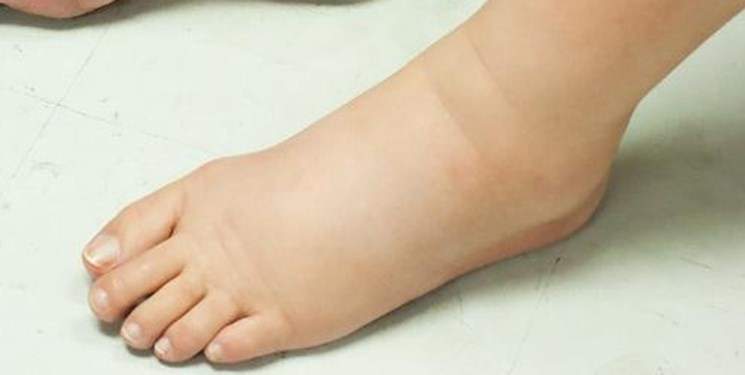 تورم پاها نشانه احتمالی نارسایی قلبی، کلیوی و کبدی است